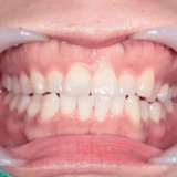 옥수동 치아미백, 치아가 노랗게 보이는 이유는?