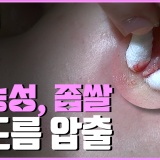 '화농성, 좁쌀 여드름' 압출 미리 보기-참진 TV, 압출킹