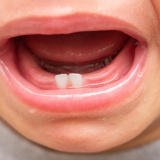 수완지구 치과 내 아이의 첫 충치, 어떻게 대처할까?