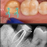크랙, 금이간 치아의 예후와 선택