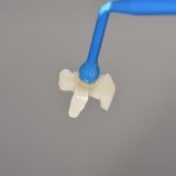 미사역 치과 인접면 충치 이맥스 세라믹 인레이 치료 하는 이유