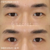 남자 쌍꺼풀수술 비절개눈매교정 35일차 시크릿성형외과