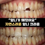 구월동 치아 파절 앞니 신경치료와 크라운으로 치료 마무리한 후기