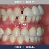 [시흥 삼성현치과] 치과 교정과 전문의 치아교정 (26)