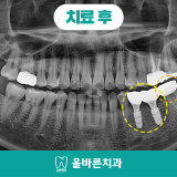 지사동임플란트 과거에 치료받은 치아에 통증이 있어요!