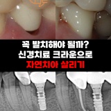 인천 간석동 양심치과 발치 진단받은 치아 신경치료로 자연치아 살리기 후기