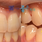 보험 충치치료 태평역치과 서울좋은치과 – 초기 충치는 모두 치료해야 할까요? 8