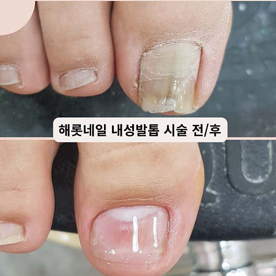 네이버 플레이스 해롯네일 발각질/내성발톱/교정/무좀 : 네이버
