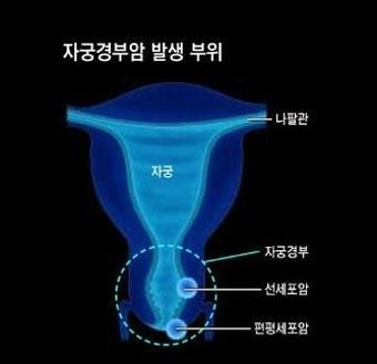 [자궁경부암예방]자궁경부암과 자궁경부암 백신