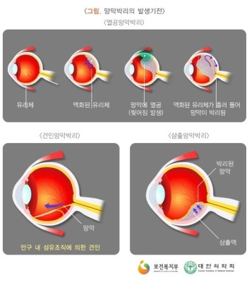[망막박리] 망막박리로 인한 눈의 위험신호? | 블로그