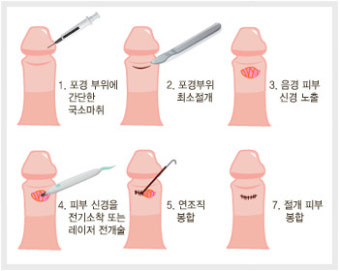조루술(Neurectomy)