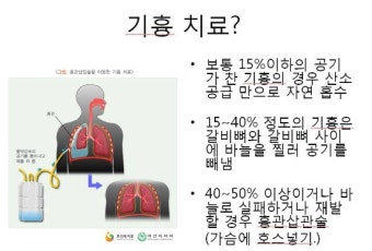기흉 수술후 재발?