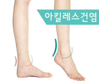 아킬레스건염부상 신발에 의해서도 발생