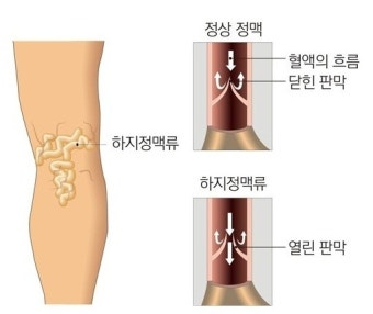 하지정맥 예방법~