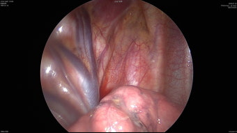 기흉 [Pneumothorax] (사진추가)