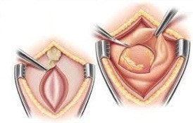 pericardial window operation