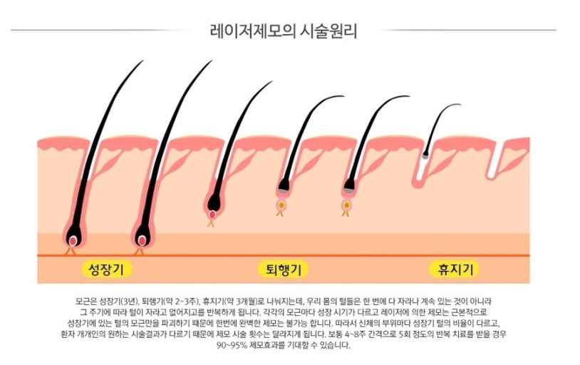 레이저 제모 지속 기간 얼마나 유지되나요?