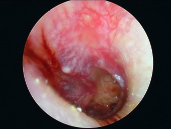 외상성 고막천공;;; 고막의 반이상이 손상되고 청력이 저하가 동반된 케이스