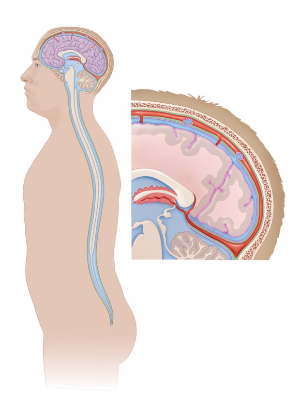 뇌수막염의 이해와 역사 그리고 예방의 중요성 2 뇌수막염