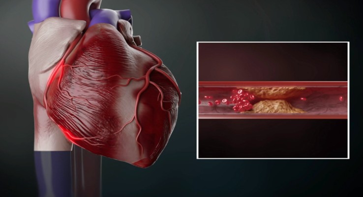 심장마비 원인과 예방, 혈류 복합관리가 필수?! | 블로그