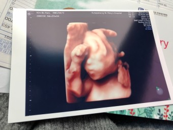 임신 6개월차 (임신20주~23주) 정밀초음파, 입체초음파, 철분제복용