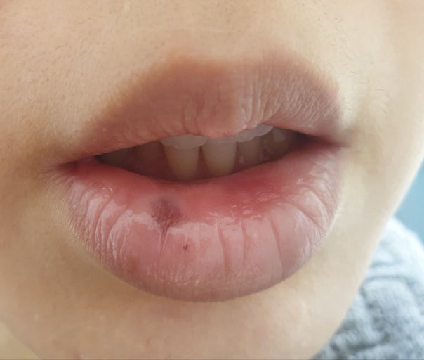 悩み)唇にできた点...?!