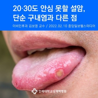 [이비인후과 김보영 교수] 20·30도 안심 못할 설암, 단순 구내염과 다른 점