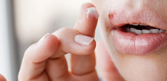 아시클로버 후기 아시클로버 연고 가격 약국 처방 입술 포진 치료