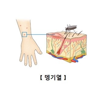 뎅기열의 이해와 역사 예방과 치료 2 뎅기열