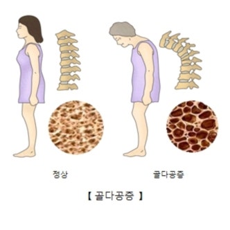 힐링 필라테스 골다공증이란?
