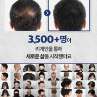 정수리두피문신 3500명 임상 보유의 비밀?