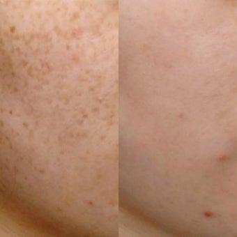 피코토닝 VS 레이저토닝 비교, 효과, 부작용, 가격, 시술 간격, 통증, 문신 제거 총정리