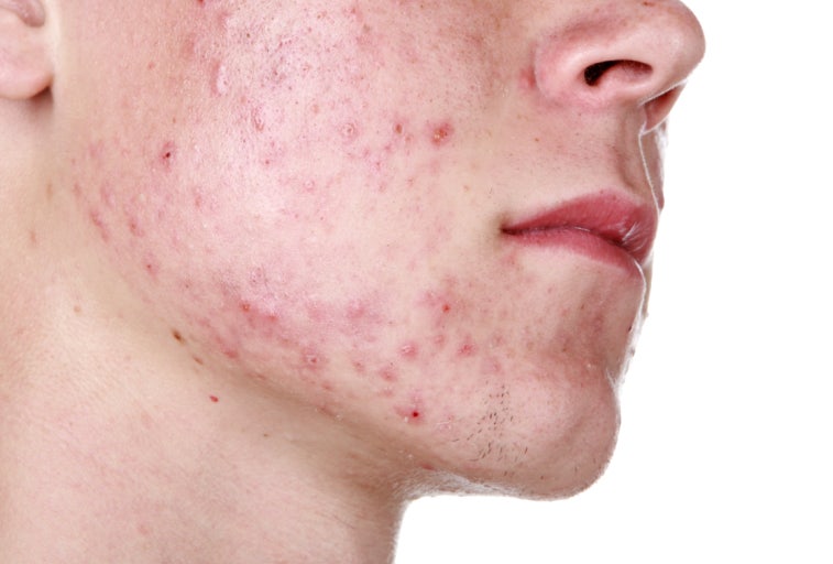 트러블 자국이나 흉터에 피부 재생 크림 효과 있을까요