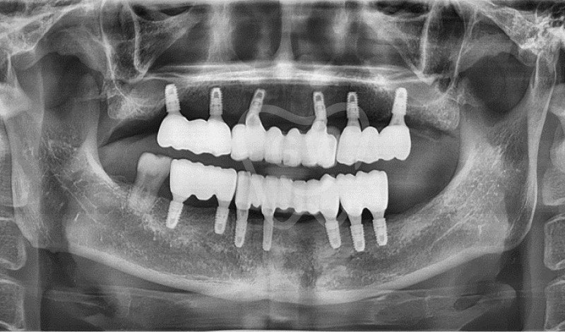 ¿El dolor de los implantes en la mandíbula superior será severo...?