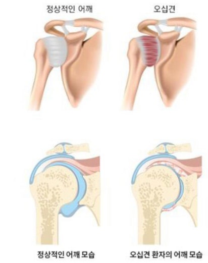 오십견의 역사, 이해, 그리고 치료법 2 오십견