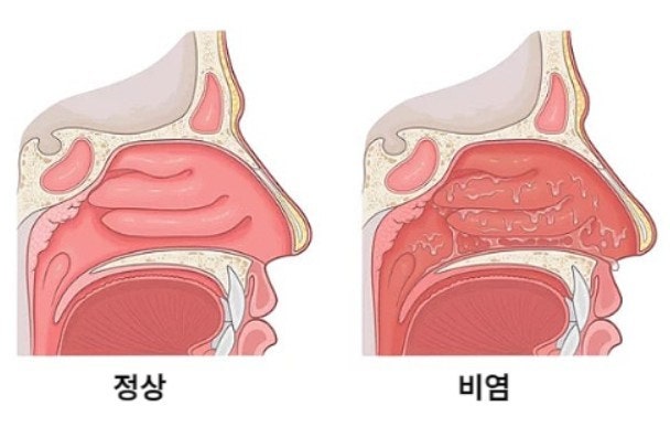 질문) 비염과 코감기의 구분이 어렵네요