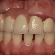 월성동 치과 잇몸 뼈 유무의 따른 임필란트 치료 사례