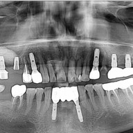 대구 임플란트 추천 치과 - 치료하던 치과가 사라질 경우에는 어떻게 해야 할까
