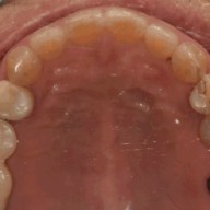 다른 치과에서 진료를 월성동 서울바른플란트 치과 에서 마무리하신 케이스