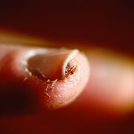 피부 진균증 곰팡이 : 발톱 손톱 사타구니 질 곰팡이균(연고)