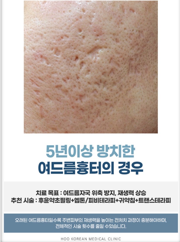 Domanda) Il trattamento per le cicatrici da acne sarà efficace?