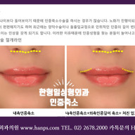 립리프팅(Lip Lifting) 인중축소수술