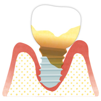 임플란트주위염 원인과 예방하는 방법
