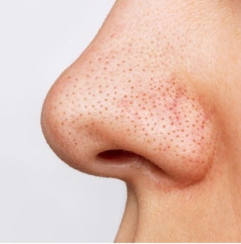 피부과 모공축소 가격 , 남자 코 모공 흉터 관리 클렌징