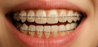 치아 교정 중 이시림, 왜 나타나는걸까요? (야탑치아교정치과)