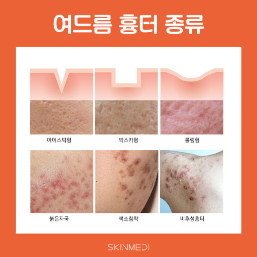 Pregunta) ¿Debo cuidar las cicatrices del acné por separado?