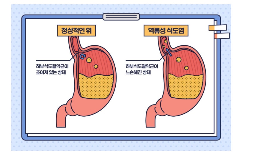 Comment traiter les symptômes persistants d'une œsophagite par reflux ?