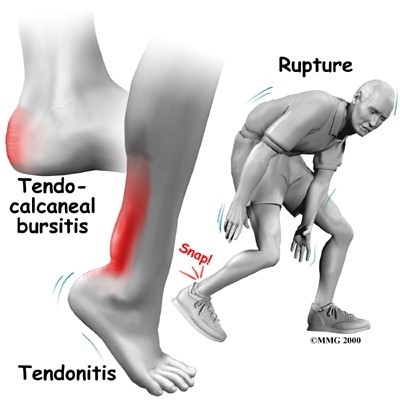 Achilles tendon of foot | 블로그