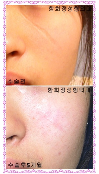 [얼굴흉터수술/함희정]오른쪽 턱부분에 있는 약 2cm 쯤 되는 흉터인데요