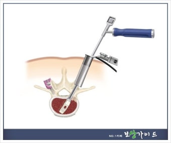 압박골절로 활동량 줄면 우울증 위험, 조기치료가 필수!